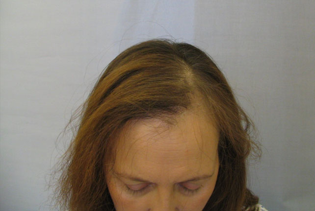 Hair loss conditions radiotherapy Hair Loss Network